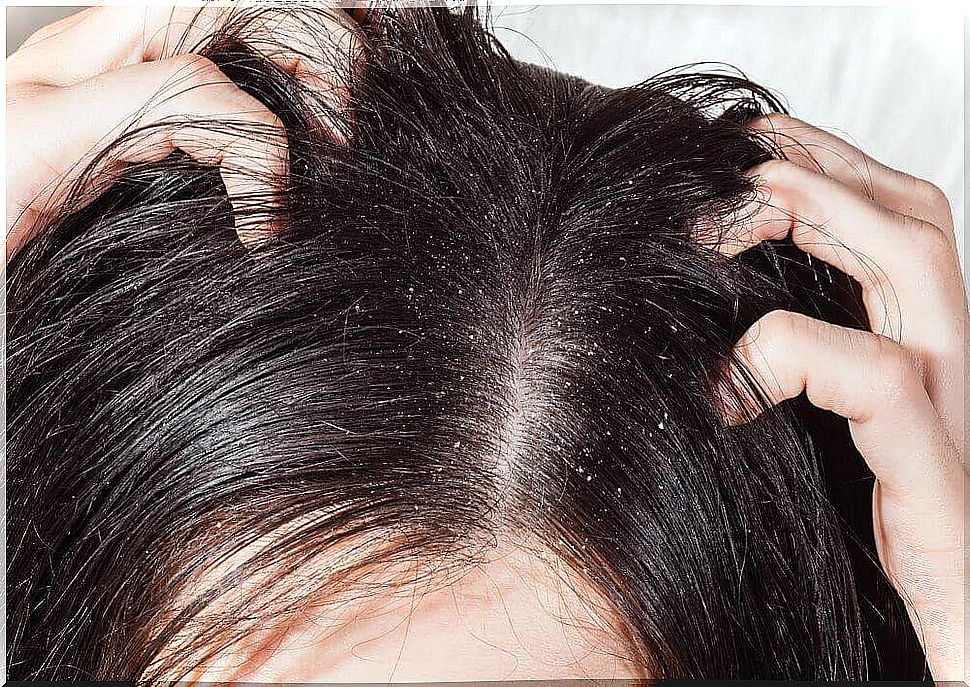 scalp infection and dandruff 