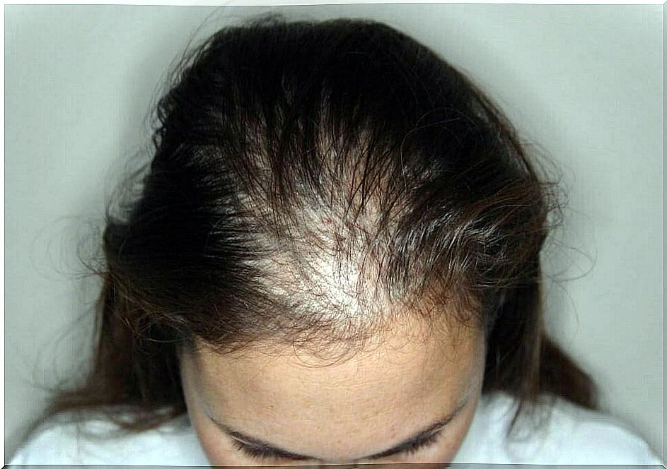 alopecia which causes hair loss