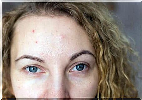 woman having acne