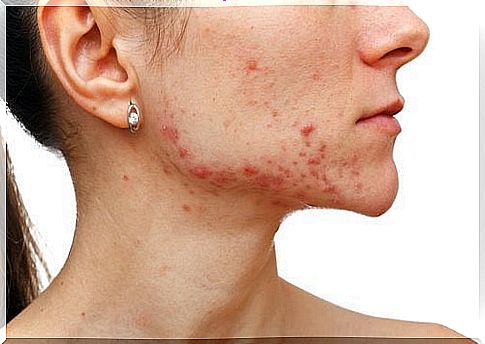 Acne-prone skin