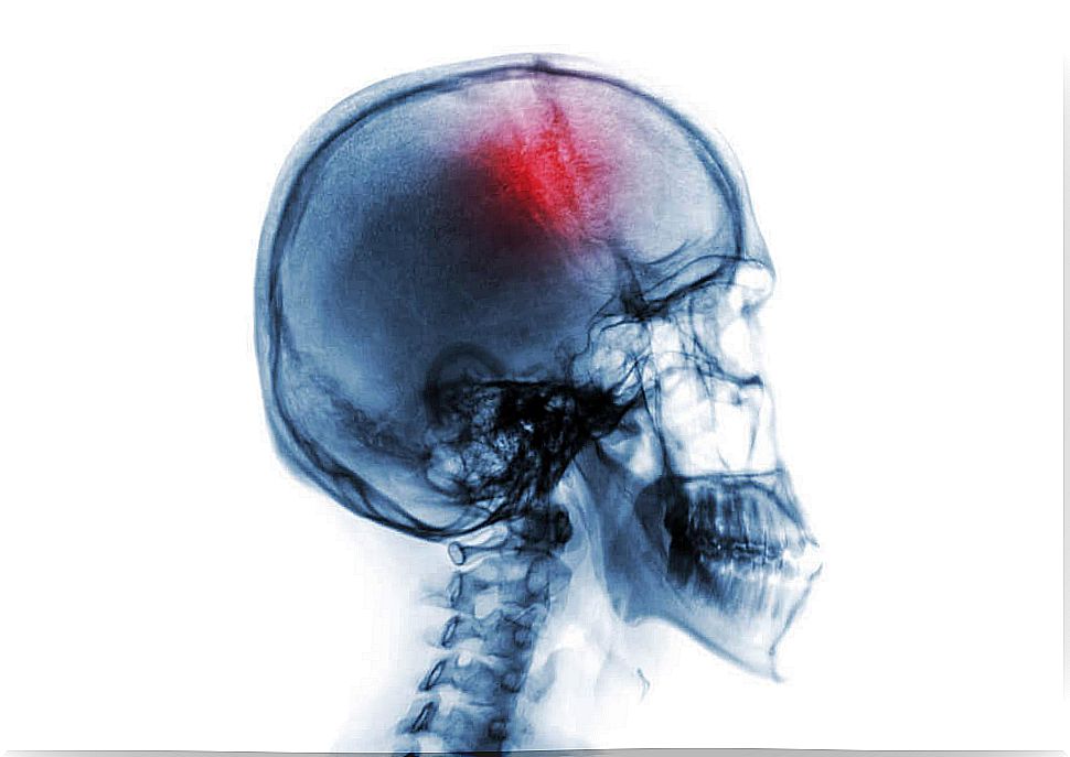 Diagram of a brain hemorrhaging in the case of a stroke