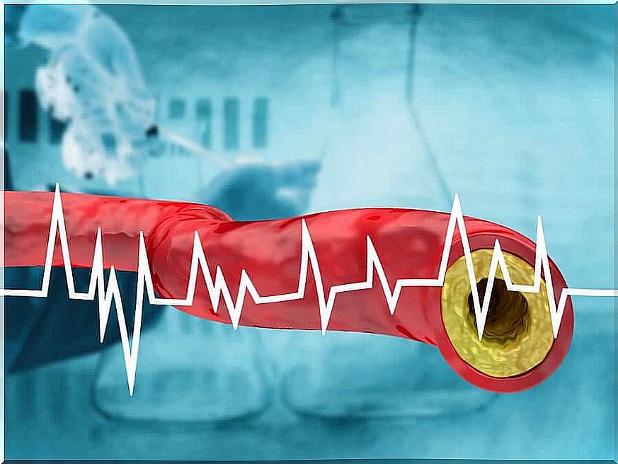 Schematic cross section of an artery with a lot of cholesterol