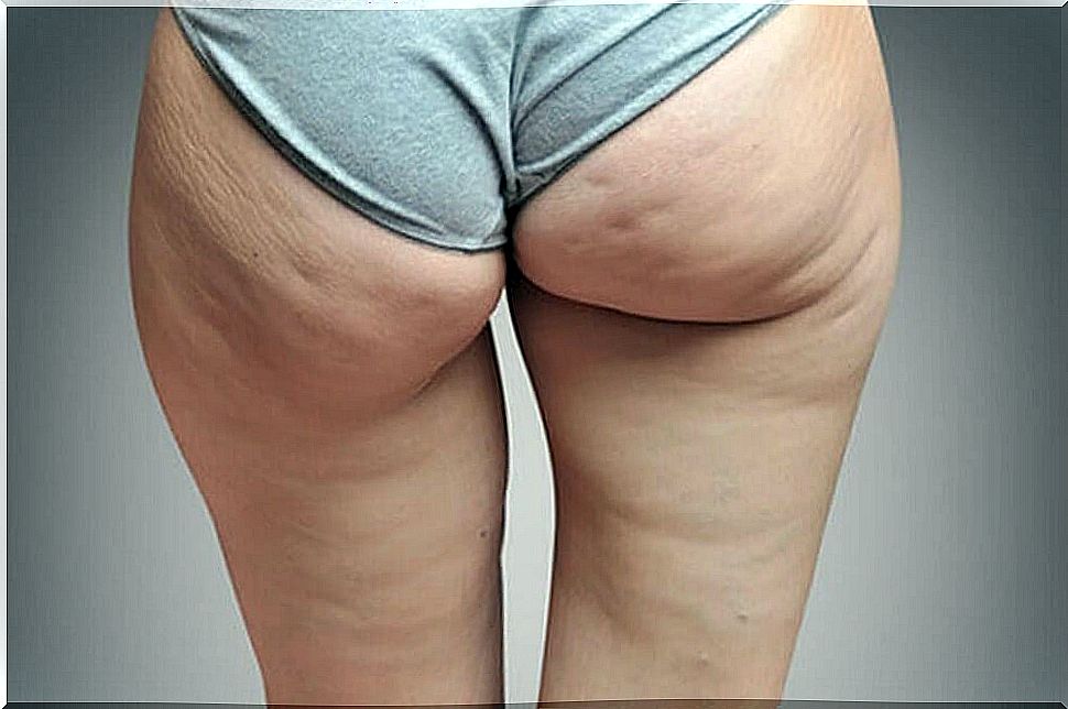 Link between water retention and cellulite