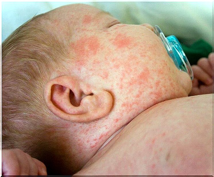 symptoms of heat rash in babies