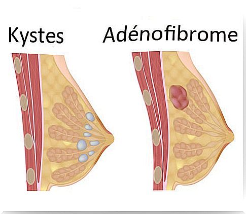 breast cysts