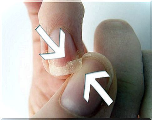 Brittle nails betray a disorder.