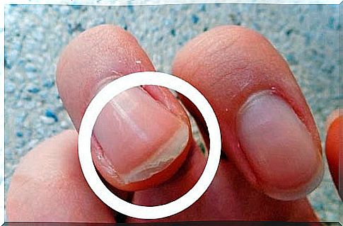 Peeling nails can indicate a health problem.