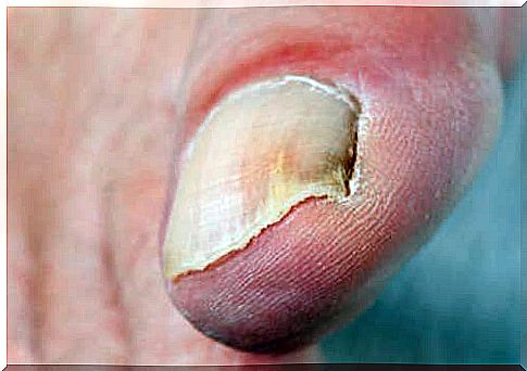 Onychomycosis is infection of a nail