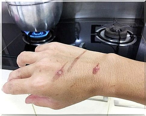 Steam and hot water burns leave marks.