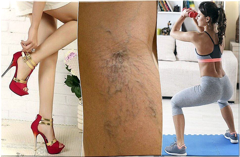 Get rid of varicose veins to beautify your legs.